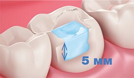 Jen Radiance Molar 1