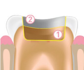 Jendental Ukraine jen radiance molar JRM tech