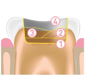 Jendental Ukraine jen radiance molar traditional tech